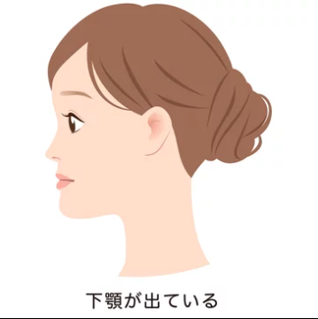 受け口（反対咬合）のイラストイメージ